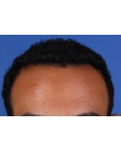 After Hair Transplant &nbsp;Front